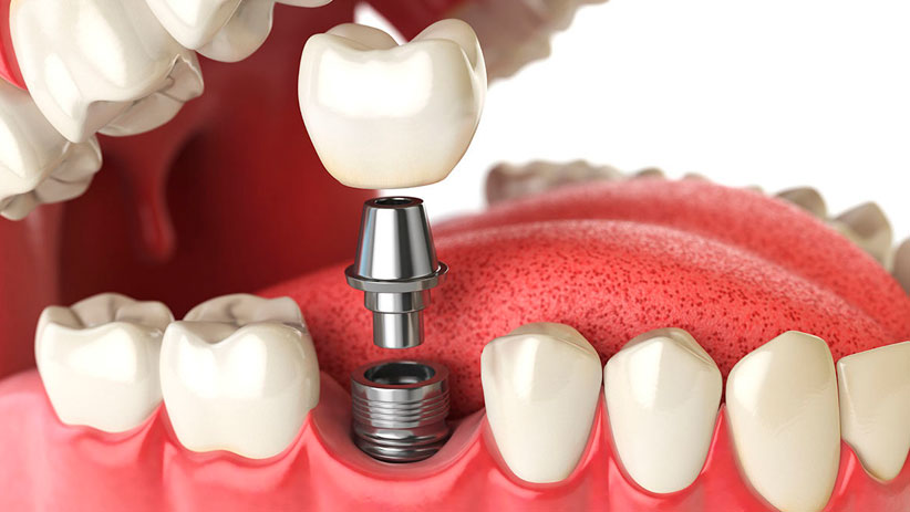 implantes-dentales-en-tijuana